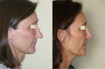 Revision Rhinoplasty before and after photo