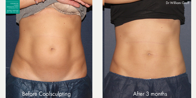 CoolSculpting before and after photo