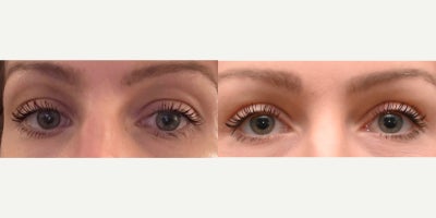 Eyelid Surgery before and after photo