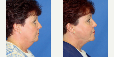 Liposuction before and after photo