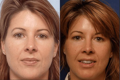 Revision Rhinoplasty before and after photo