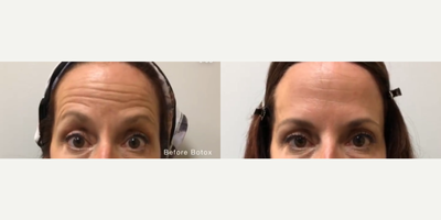 Botox before and after photo