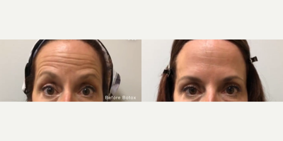 Botox before and after photo