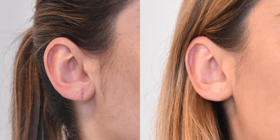 Earlobe Repair before and after photo