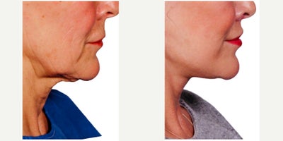Facelift before and after photo