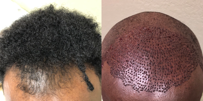 FUE Hair Transplant before and after photo