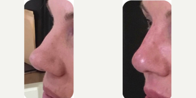 Nonsurgical Nose Job before and after photo