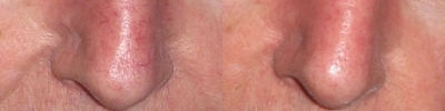 Sclerotherapy before and after photo