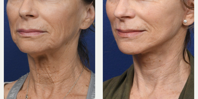 Facelift before and after photo