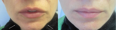 Radiesse before and after photo