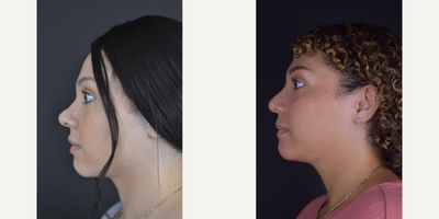 African American Rhinoplasty before and after photo