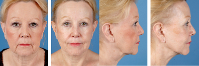 Facelift before and after photo