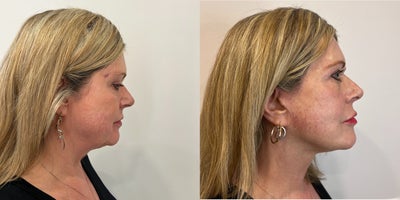 Neck Lift before and after photo