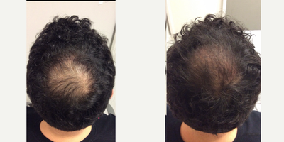 PRP for Hair Loss before and after photo