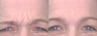 Botox before and after photo
