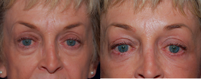 Brow Lift before and after photo