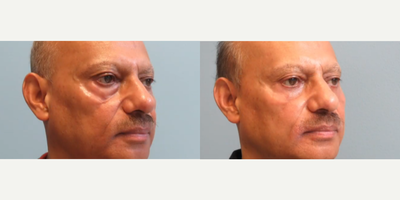 Eyelid Surgery before and after photo