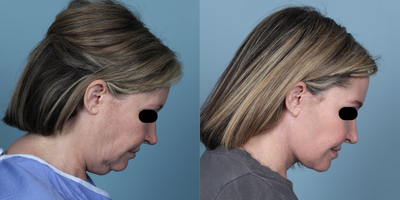 Facelift before and after photo