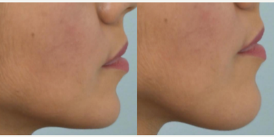 Genioplasty before and after photo