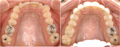 Invisalign before and after photo
