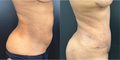 Tummy Tuck before and after photo