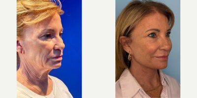 Deep Plane Facelift before and after photo