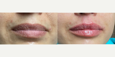 Lip Fillers before and after photo