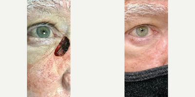 Mohs Surgery before and after photo