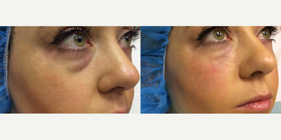 Restylane Defyne before and after photo