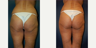Butt Lift before and after photo