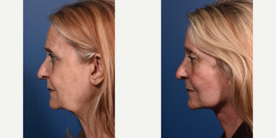 Deep Plane Facelift before and after photo