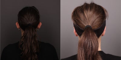 Ear Surgery before and after photo