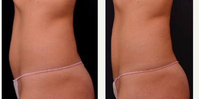 Exilis before and after photo