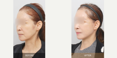 Facelift Revision before and after photo