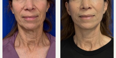 Facelift before and after photo