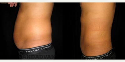 Liposuction before and after photo