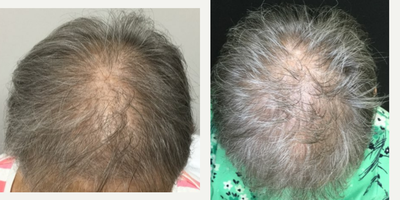 PRP for Hair Loss before and after photo