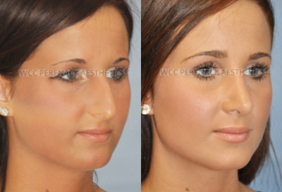 Rhinoplasty before and after photo