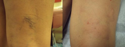 Sclerotherapy before and after photo