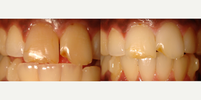Teeth Whitening before and after photo