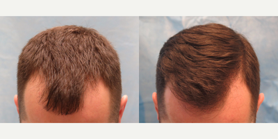 ARTAS Robotic Hair Transplant before and after photo