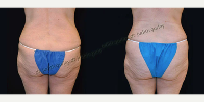 Body Lift before and after photo