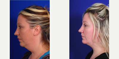 Chin Liposuction before and after photo