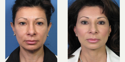 Eyelid Surgery before and after photo