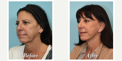 Facelift before and after photo
