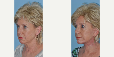 Facelift before and after photo