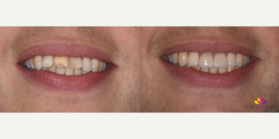 Invisalign before and after photo