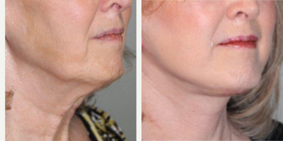 Neck Lift before and after photo