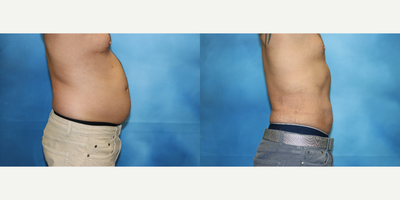 Liposuction before and after photo