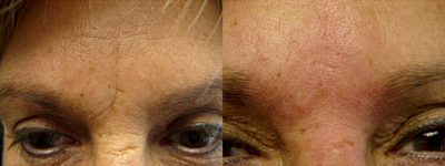 Restylane before and after photo